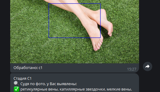 AI-диагностика варикоза — пример работы алгоритма